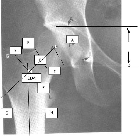 Figure 1 From Collodiaphyseal Angle In The Diagnosis Of Coxa Vara And