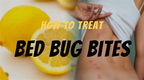 Bed Bug Bite Relief Effective Ways To Treat Bed Bug Bites Remedies