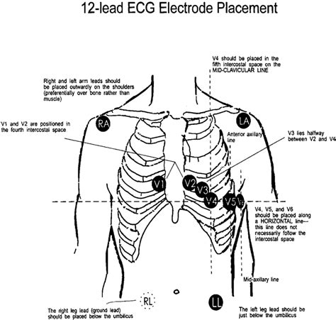 Placement Of 12 Lead Ecg Electrodes Ra Indicates Right Arm La Left