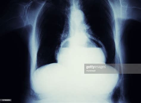 Hernia Of The Stomach High Res Stock Photo Getty Images