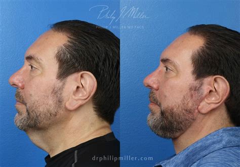 6 Facts About Male Facelift You Didnt Know Philip Miller Md