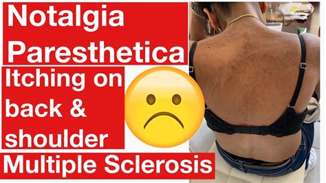 Notalgia Paresthetica Itching Back And Shoulder With Multiple Sclerosis