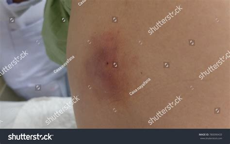 Infected Sebaceous Cyst Complicated Abscess Formation Stockfoto