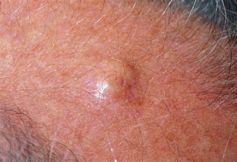 Sebaceous Cyst On Scalp Stock Image M1300223 Science Photo Library