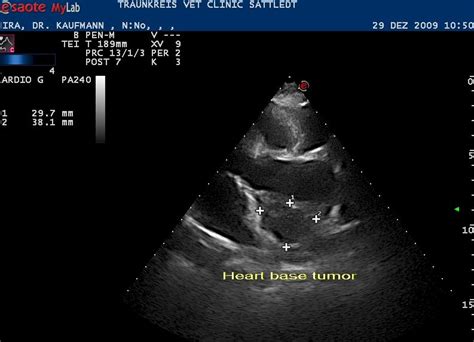 heart based tumor sonopath