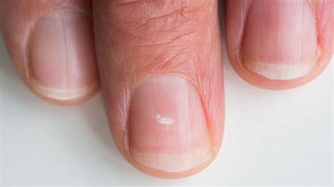 Ridges In Fingernails Toenails Vertical Horizontal Vitamin