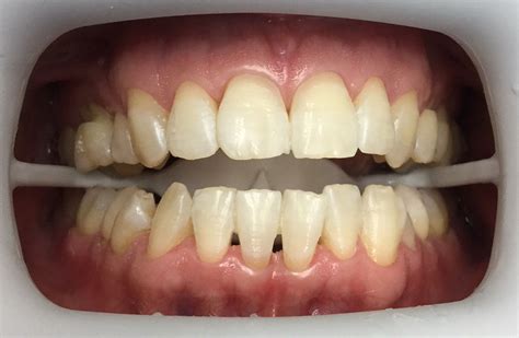 Um bis zu 8 farbnuancen weissere zähne erfahren sie mehr. Bleaching/Zahnaufhellung Vorher-Nachher - Die Vollkeramik ...
