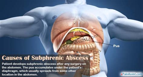 Subphrenic Abscesscausessignssymptomstreatment