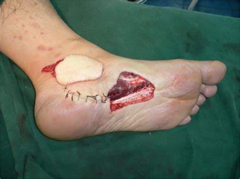 Heel reconstruction with free instep flap: a case report ...