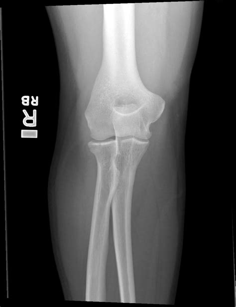 Radial Head Fracture Non Displaced Image