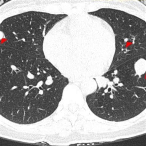 A Ct Scan Image Of The Chest During Follow Up 8 Months After Diagnosis