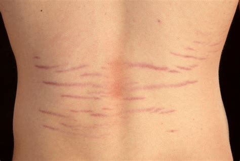 A Teenager With Lumbar Striae Distensae When A Bruise Is Not A Bruise
