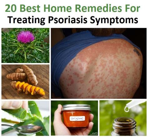 20 Meilleurs Remèdes Maison Pour Traiter Le Psoriasis Symptômes