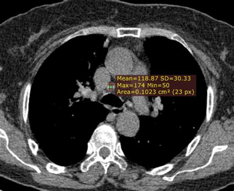 Unenhanced Ct Image Shows Lymph Node In Right Lower Paratracheal With
