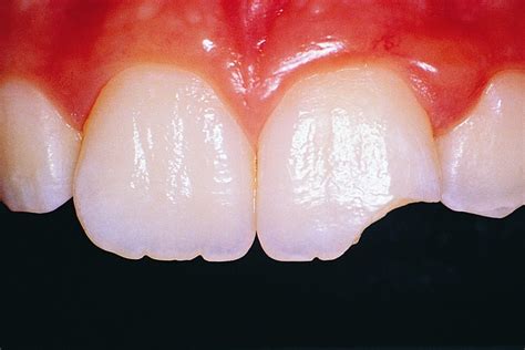 Fractura Dental Causas Y Como Identificarlas — Odontologic