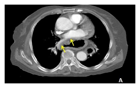 Axial And Coronal Images Of The Hiatal Hernia On Thoracoabdominal Ct
