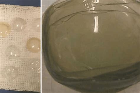 Doctor Finds Lost Contact Lenses In Woman S Eye Nobody Can Believe