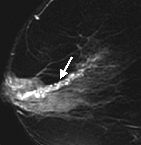 ductal carcinoma in situ of the breast mr imaging findings with histopathologic correlation