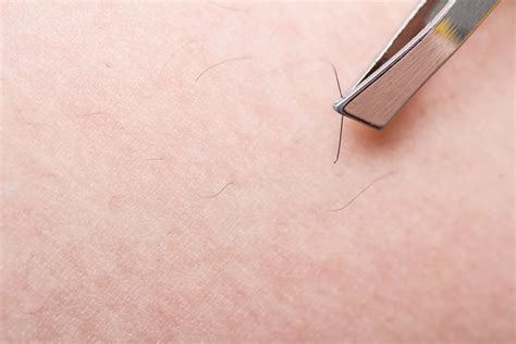 Helpful Tips To Preventing And Treating Ingrown Hair