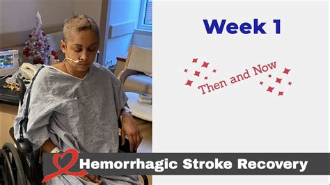 Stroke Recovery Week 1 Then And Now Stroke Recovery Stories Youtube