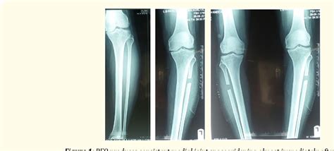 Figure 1 From Pfo Proximal Fibular Osteotomy In Medial Compartment