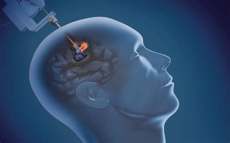 New Laser Option For Treatment Of Epilepsy At Uc San Diego Health