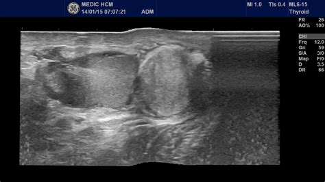 VIETNAMESE MEDIC ULTRASOUND CASE 296 TUMOR Of TESTES Dr PHAN THANH