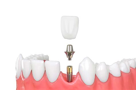 Dental Implant And Crown Is This Combination Right For You