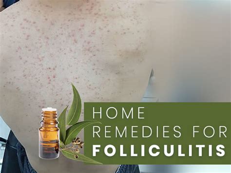 Folliculitis Simple And Effective Home Remedies