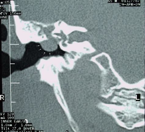 Temporal Bone Ct Coronal Showing A Soft Tissue Mass Occupying The