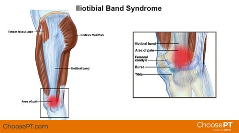 Iliotibial Band Syndrome Itbs Or It Band Syndrome