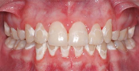 Living With Braces Prevent White Spots On Your Teeth Dental
