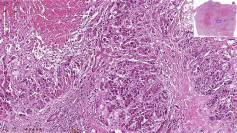 Hepatocellular Carcinoma Histopathology Youtube