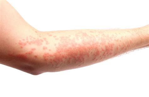 10 Habits That Triggers Hives Urticaria And Remedy Health Gadgetsng