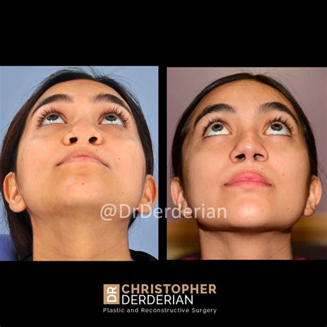 Cleft Rhinoplasty — Dr Derderian — Plastic And Reconstructive Surgery