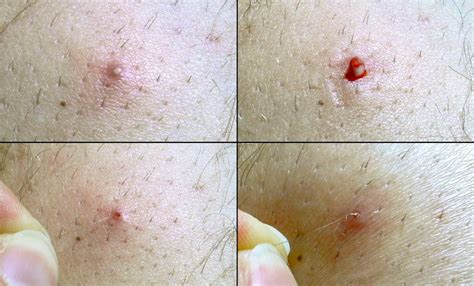 Ingrown Hairs Where They Happen Why And How To Treat