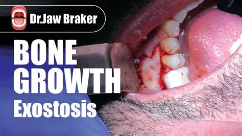 Exostosis Bone Growth Youtube