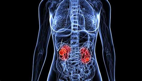 Kidney Cancer Diagnosis Johns Hopkins Medicine