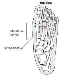 Learn about the causes, symptoms, treatment & prevention strategies for foot stress fractures foot problems usually affect people who have suddenly increased their activity levels, whether it be that they've taken up a new. Stress Fracture Q&A | ZappoMan.wordpress.com - Fitness Blog