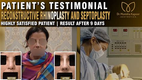 Nose Job A Patients Testimonial Delhi India By Dr Monisha Kapoor Before And After Results
