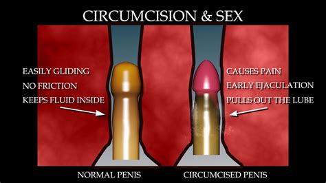 Circumcision And Sex Youtube