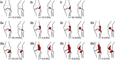 Illustration Of The Classification And Frequency Of Bone Bruises In The