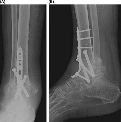 Anterioposterior Radiograph Demonstrating A Primary Ankle Fusion That