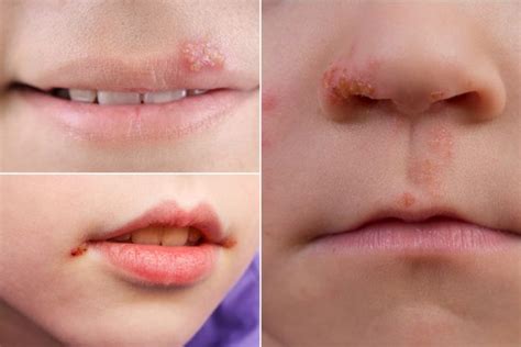 Cold Sores Fever Blisters In Kids Causes And Treatment