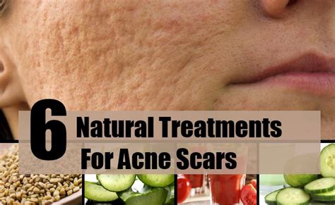 6 Effective Natural Treatments For Acne Scars Best Home