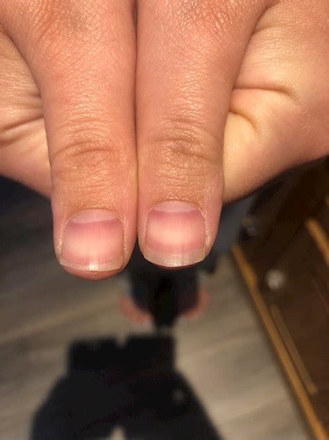 Finger Nail Changes Can Anybody Tell Scleroderma And Ray
