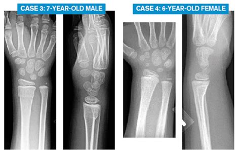Signs Of A Broken Wrist In A Child What Signs Should Parents Be