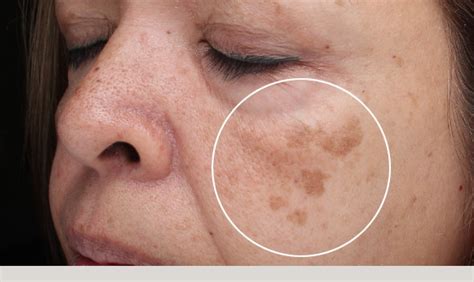 Dermatology Center Of Loudoun Blog Brown Spots Age Spots