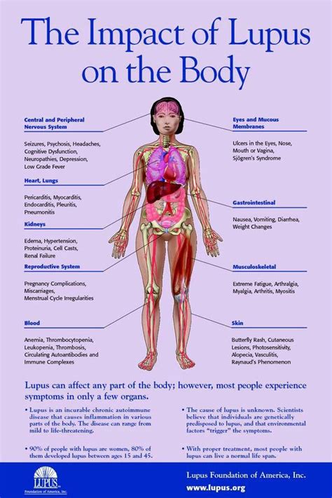 Impact Of Lupus On The Body Lupus Healthcare Chronic Fatigue Chronic