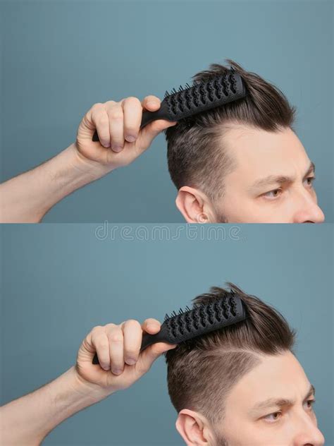 Smoking causes inflammation throughout the body, which can worsen hair loss. Young Man With Hair Loss Problem Stock Photo - Image of ...